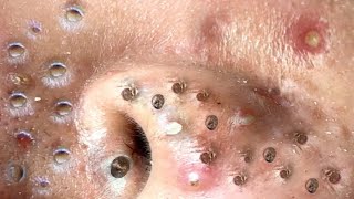 blackheads new 2023  popping pimple today  blackheads and whiteheads removal [upl. by Doralin]