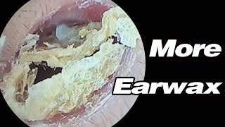 Ear Picking Earwax Is Super Heavy And Its Blocking My HearingASMRearwax耳掃除 [upl. by Baecher]