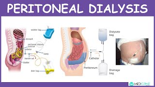 Peritoneal Dialysis Introduction Physiology Technique Modes and Complications [upl. by Cassady846]