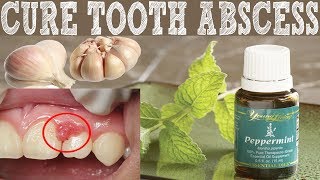 How To Cure Tooth Abscess naturally  Home Remedies To Cure Tooth Abscess [upl. by Amorete]