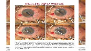 Endothelial keratoplasty DMEK DSEK DLEK PDEK Ophthalmology [upl. by Humbert]