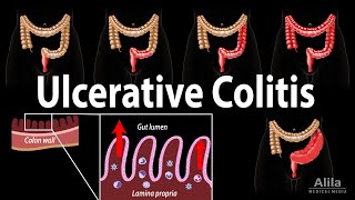 Ulcerative Colitis Pathophysiology Symptoms Risk factors Diagnosis and Treatments Animation [upl. by Kuth]