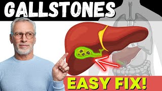 DISSOLVE GALLSTONES Permanently [upl. by Rosemari]