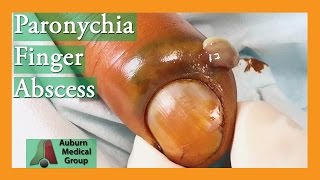 Paronychia Fingernail Abscess Infection Treatment  Auburn Medical Group [upl. by Garibald]