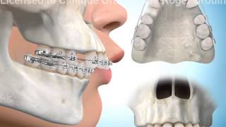 Extractions de dents pour correction surplomb horizontal [upl. by Geller]