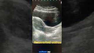 Anteverted uterus ultrasound shortfeed medical uterus pelvic pelvis study shortsviral short [upl. by Akinet]