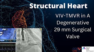 VIVTMVR in A Degenerative 29 mm Surgical Valve [upl. by Thun645]