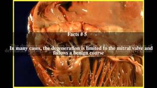 Myxomatous degeneration Top  7 Facts [upl. by Sil287]