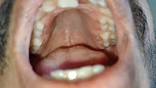 HighArched Palate Examination [upl. by Amahs]