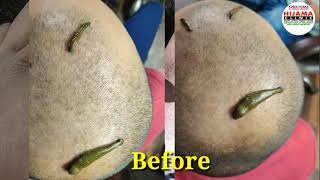 Hair regrowth treatmentStop Hair fallleech oilComplete Hair SolutionLeech therapy [upl. by Elbertina836]