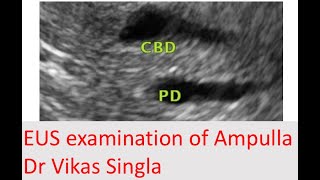 Learning video for EUS EUS examination of Ampulla [upl. by Bruning596]