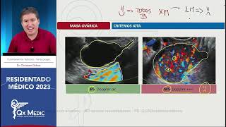 Ginecología  14 Masa ovárica benigna [upl. by Anitnahs895]