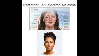 Treatment For Epidermal Melasma [upl. by Alwin914]