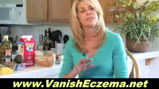 The Best Possible Ways For Eczema Relief [upl. by Yasdnyl819]