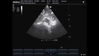 transmitted pulsation to consolidated lung lobe [upl. by Anella159]