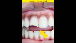 This is how to restore a chipped tooth to new condition [upl. by Nuzzi]