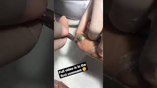 Removing a old toenail full of mycosis and fungus 👣 satisfying [upl. by Pall122]