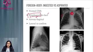 Video No 48 Radiology Approach To a Foreign Body On Chest XRay [upl. by Nivled271]