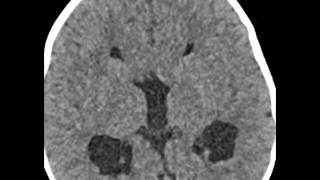 Heterotopic Gray Matter [upl. by Markowitz24]