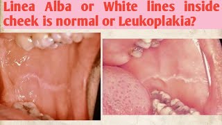 Linea Alba or White lines inside cheek is normal or Leukoplakia [upl. by Nospmis]