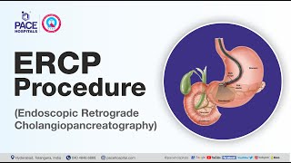 What is ERCP Test and How it is done  Department of Gastroenterology  Pace Hospitals [upl. by Eicrad]