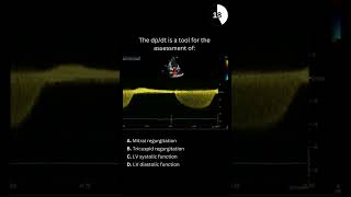 Echocardiography board practice question 29 [upl. by Pavier876]