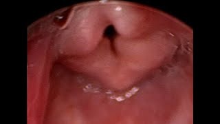 Laryngobronchoscopy  Laryngomalacia in a newborn baby [upl. by Leizo]