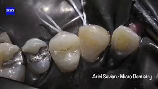 Restoring Teeth without Root Canal Treatment Effective Caries Removal and Crown Restoration [upl. by Yrrehs]