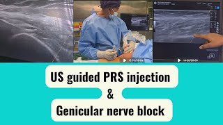 Ultrasound guided PRS injections  genicular nerve block [upl. by Ennyrb671]