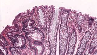 Colon tubular adenoma demonstrating low grade dysplasia  Microscopic diagnosis [upl. by Donelu652]