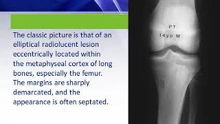 Non ossifying fibroma DrMSubbiah MD Pediatrics [upl. by Nirro543]