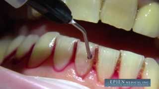 HybenX Supra Gingival Application [upl. by Trudey]