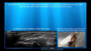 Ultrasound Guided Platelet Rich Plasma Injection for Lateral EpicondylitisPartial Tear [upl. by Matilde]