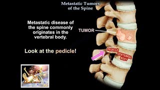 Metastatic Tumors Of The Spine  Everything You Need To Know  Dr Nabil Ebraheim [upl. by Golda185]