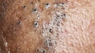 Blackheads amp Whiteheads Satisfying Removal 0050 [upl. by Ybeloc]