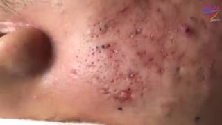 BLACKHEADS REMOVAL on face  how to get rid of blackheads amp whiteheads series acne treatment 0200 [upl. by Ecitnirp]