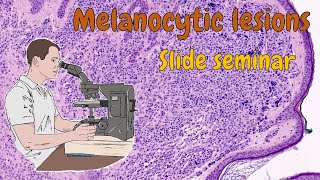 Melanocytic lesions ENG [upl. by Eissirhc]