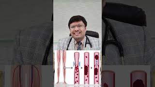 डीवीटी में कैथेटर लाइसिस Ultimate Guide to CATHETER LYSIS IN DVT  Risk Benefits Recovery [upl. by Antonetta]