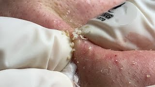 Acne Treatment Huong Da Nang576  2023 [upl. by Silvers]