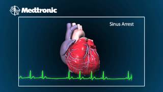 What Is Bradycardia [upl. by Collen]