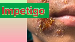 Impetigo in childrenबच्चो में होने बाले फोड़े फ़िन्सी [upl. by Isoais]