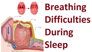 Methods to Improve Breathing Difficulties During Sleep by Prof John Mew [upl. by Eninnaj585]