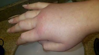 Difference Between Urticaria and Angioedema [upl. by Hessler754]