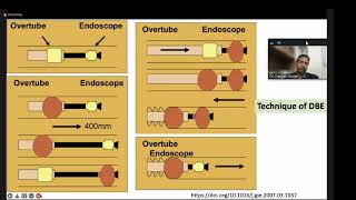 Endoscopy lectures Enteroscopy amp Polypectomy [upl. by Orvil639]