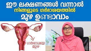 ഗർഭാശയത്തിൽ മുഴ ഉണ്ടോ ഈ ലക്ഷണങ്ങളിലൂടെ തിരിച്ചറിയാം  Fibroid Treatment Malayalam  Health Tips [upl. by Elitnahc18]