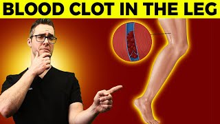 Blood Clot in the Leg  Early signs Symptoms How to Check amp Causes [upl. by Jarad]