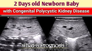 Newborn Baby with Congenital Polycystic Kidney Disease  Ultrasound [upl. by Anrat]