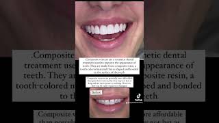 Composite veneers smilemakeover dentistteeth dentist iteethdental duet bestdentist viralreels [upl. by Aniala179]