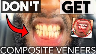 DONT GET COMPOSITE VENEERS UNTIL YOU WATCH THIS  Composite vs Porcelain Veneers  COOPSCORNER [upl. by Vaughn403]