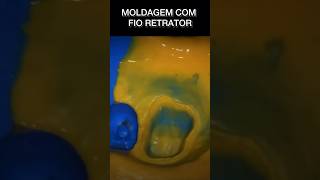 MOLDAGEM COM FIO RETRATOR oral moldagem bucal shortsvideo shortsfeed moldagem protese [upl. by Nosde]